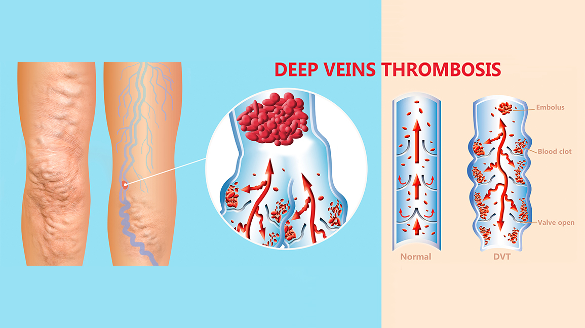Deep Vein Thrombosis: Myths & Facts - Sierra Hematology & Oncology